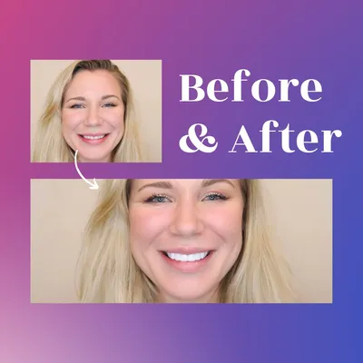 Removable Veneers